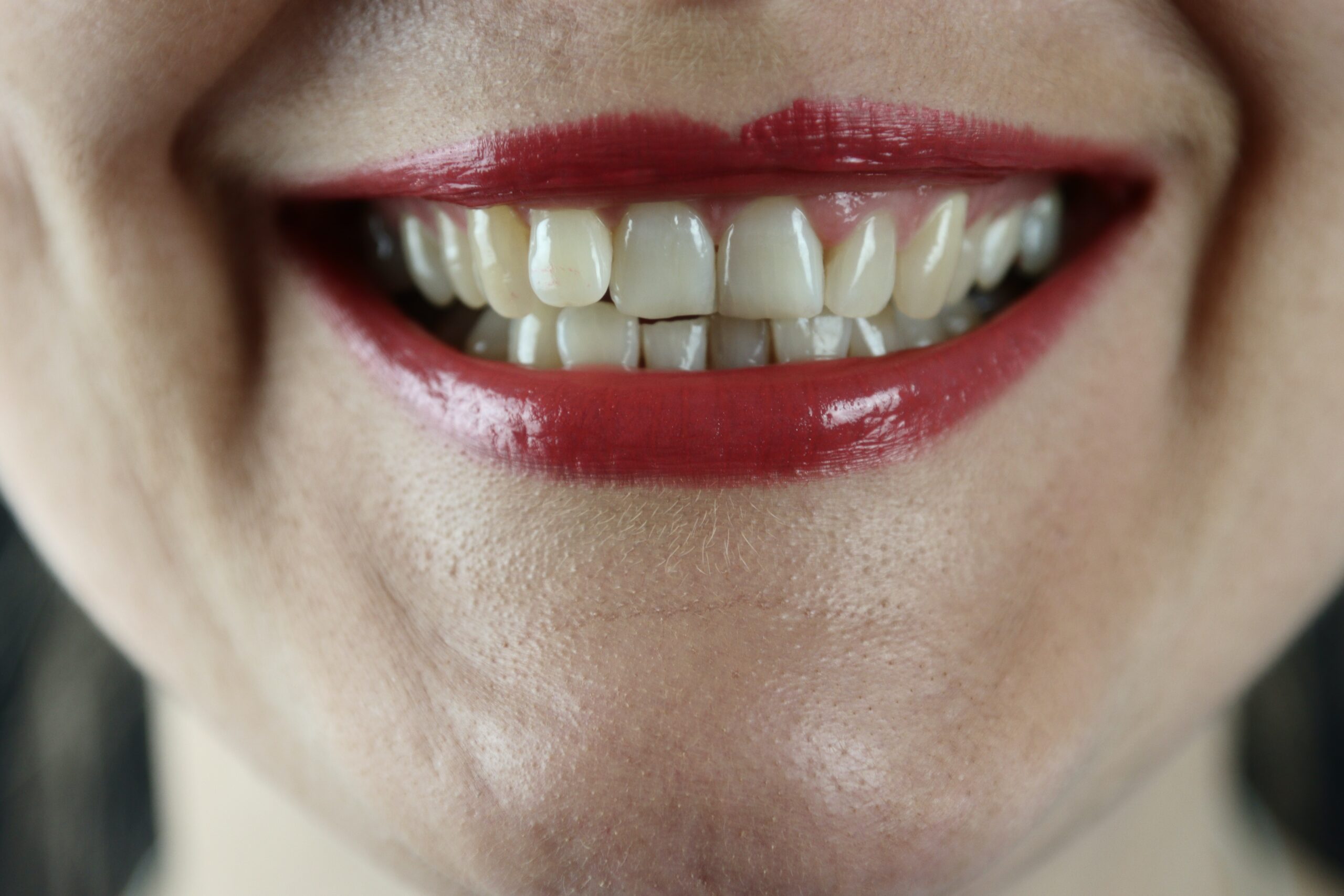 The Best Teeth Whitening Strips